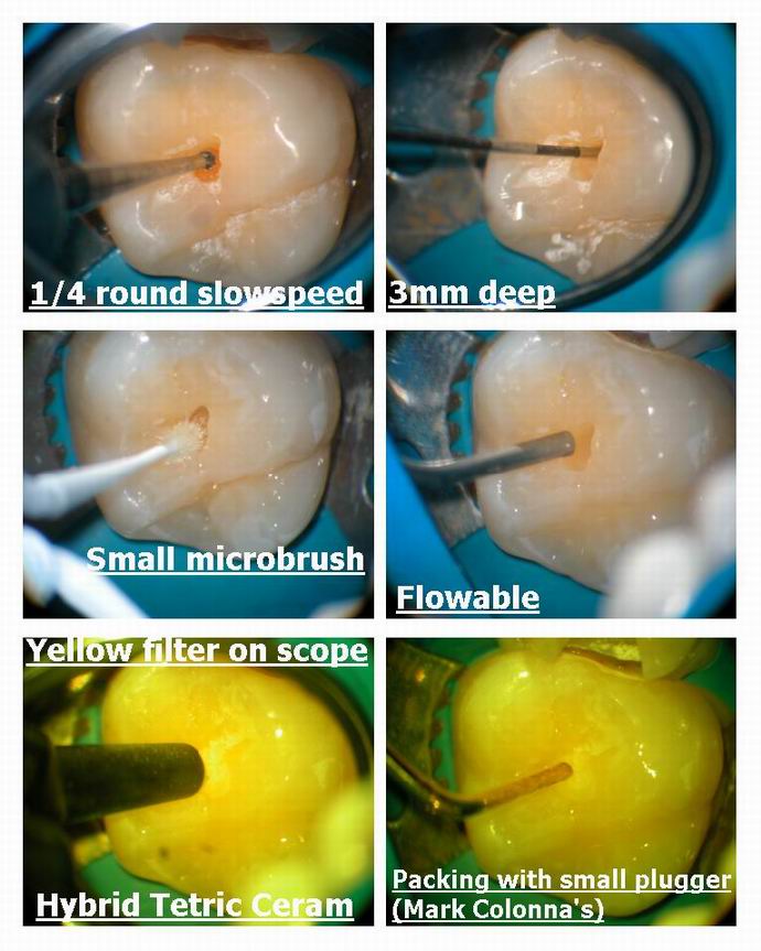 Resize of Microdental bubble in FS pg 2.jpg